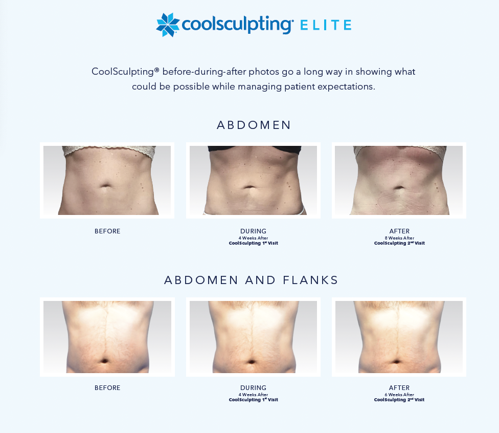 Coolsculpting Mankato